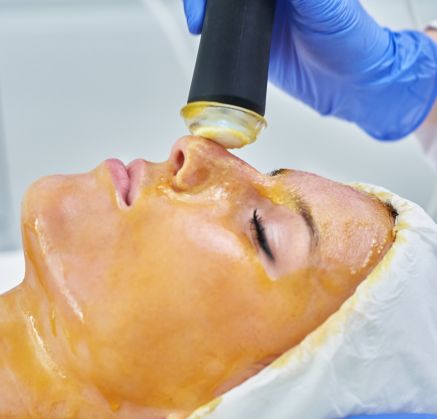 Chemical Peel Richmond