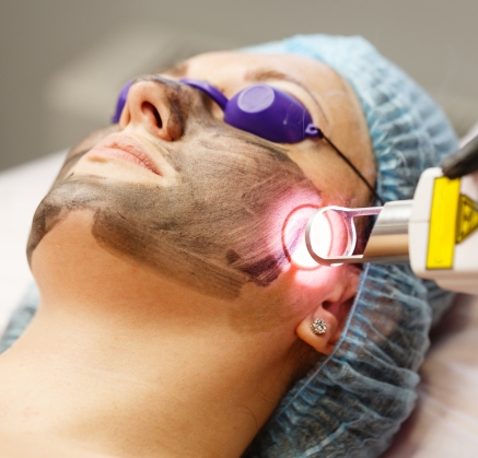 Carbon Peel Laser Treatment Richmond