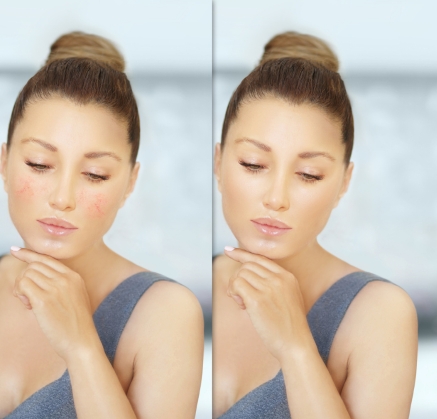 Diffuse Redness Facial Richmond