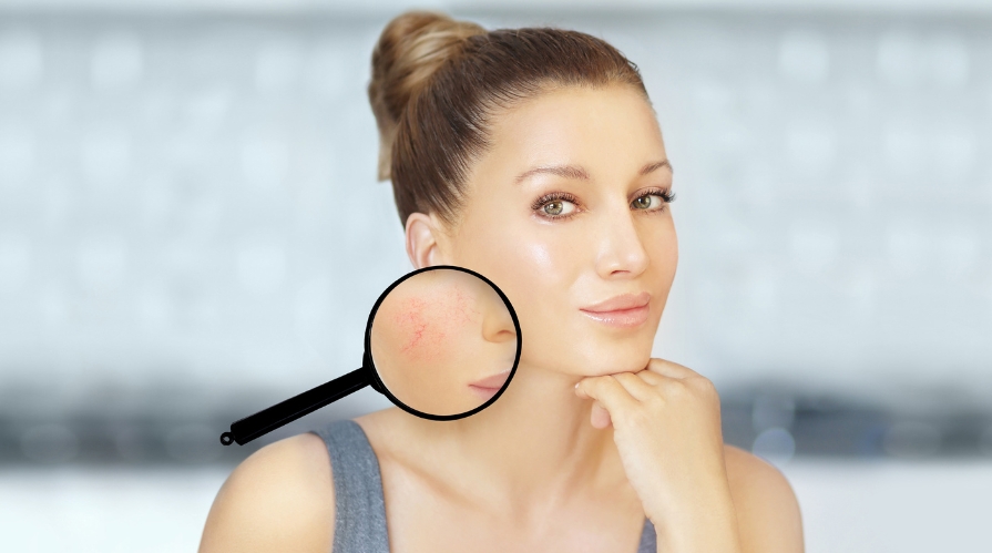 Diffuse Redness Facial Richmond