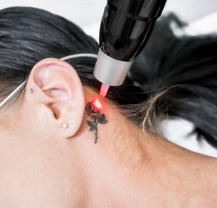 Tattoo Removal in Richmond