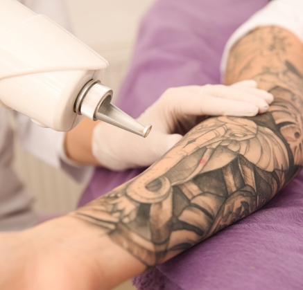 Tattoo Removal in Richmond
