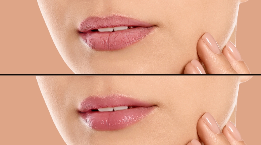Lip Neutralization Richmond