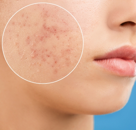 Acne Laser Facial Richmond
