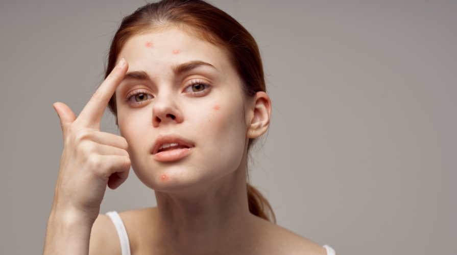 Acne Laser Facial Richmond