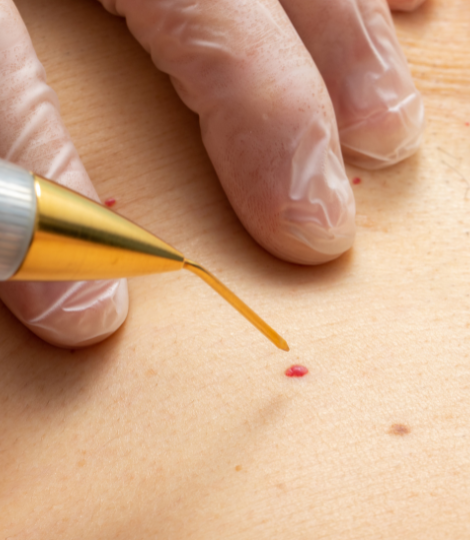 Plasma pen training in Melbourne